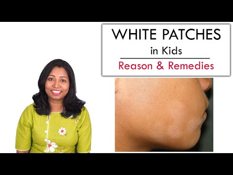 White Patches in Kids face – Reason, Care & Remedy
