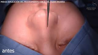 RINOPLASTIA ESTRUCTURADA - REDEFINICIÓN DE PUNTA