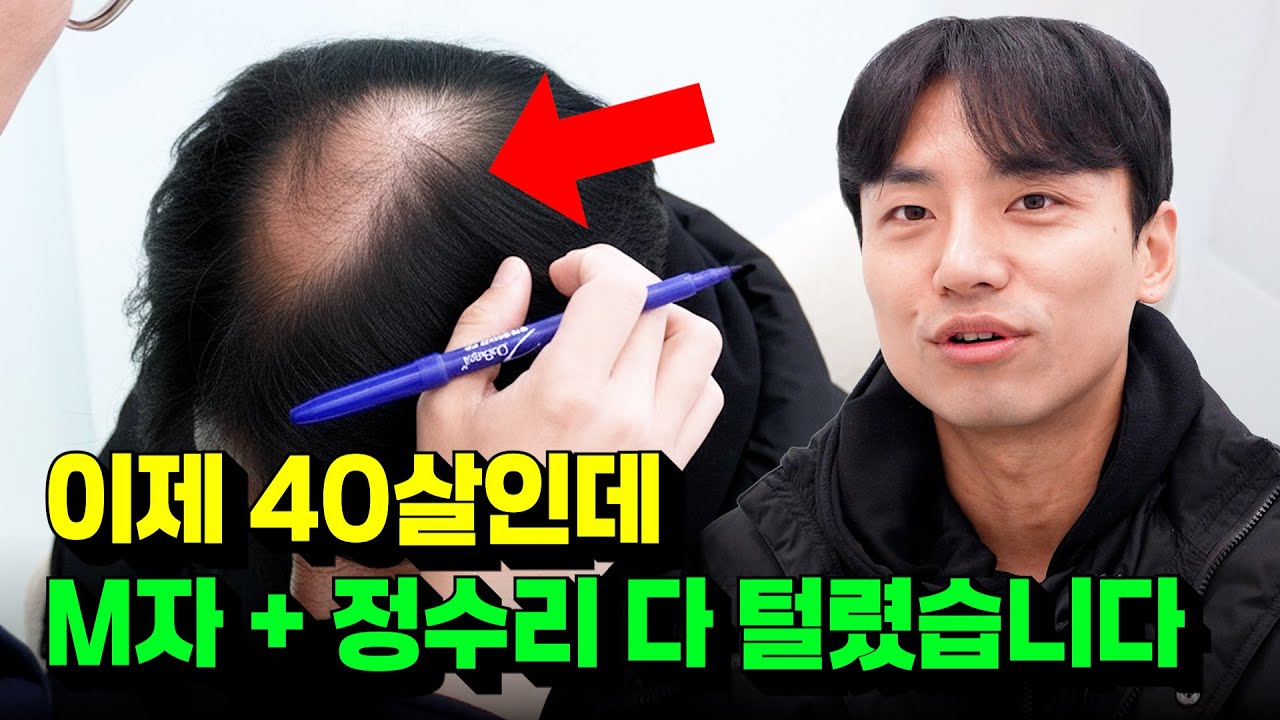40대는 뚜껑 싸움! 그래서 미리 모발이식합니다