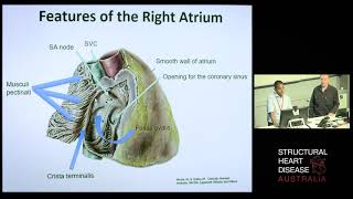 Anatomy of the Right Heart – Dr Sean Lal