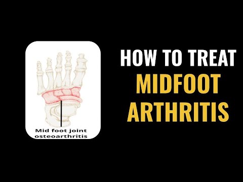Midfoot Arthritis Treatment Options - Complete Ways to SOLVE MIDFOOT PAIN