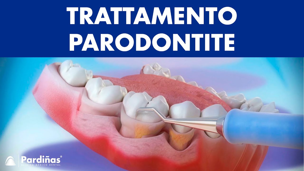 Watch Now Trattamento parodontite – Curettage e sondaggio parodontale © Trattamento parodontite – Curettage e sondaggio parodontale ©