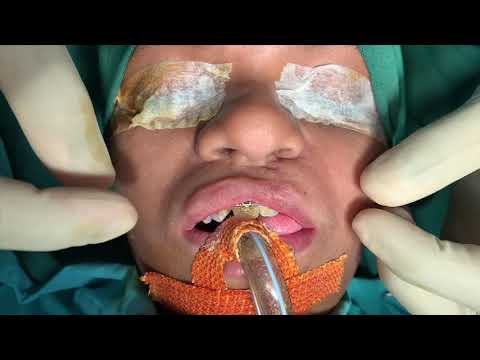 Lip Revision With Alar And Nasal Sill Plasty