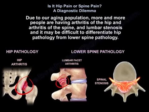 Ból biodra czy kręgosłupa? Jak rozpoznać prawdziwe źródło dolegliwości