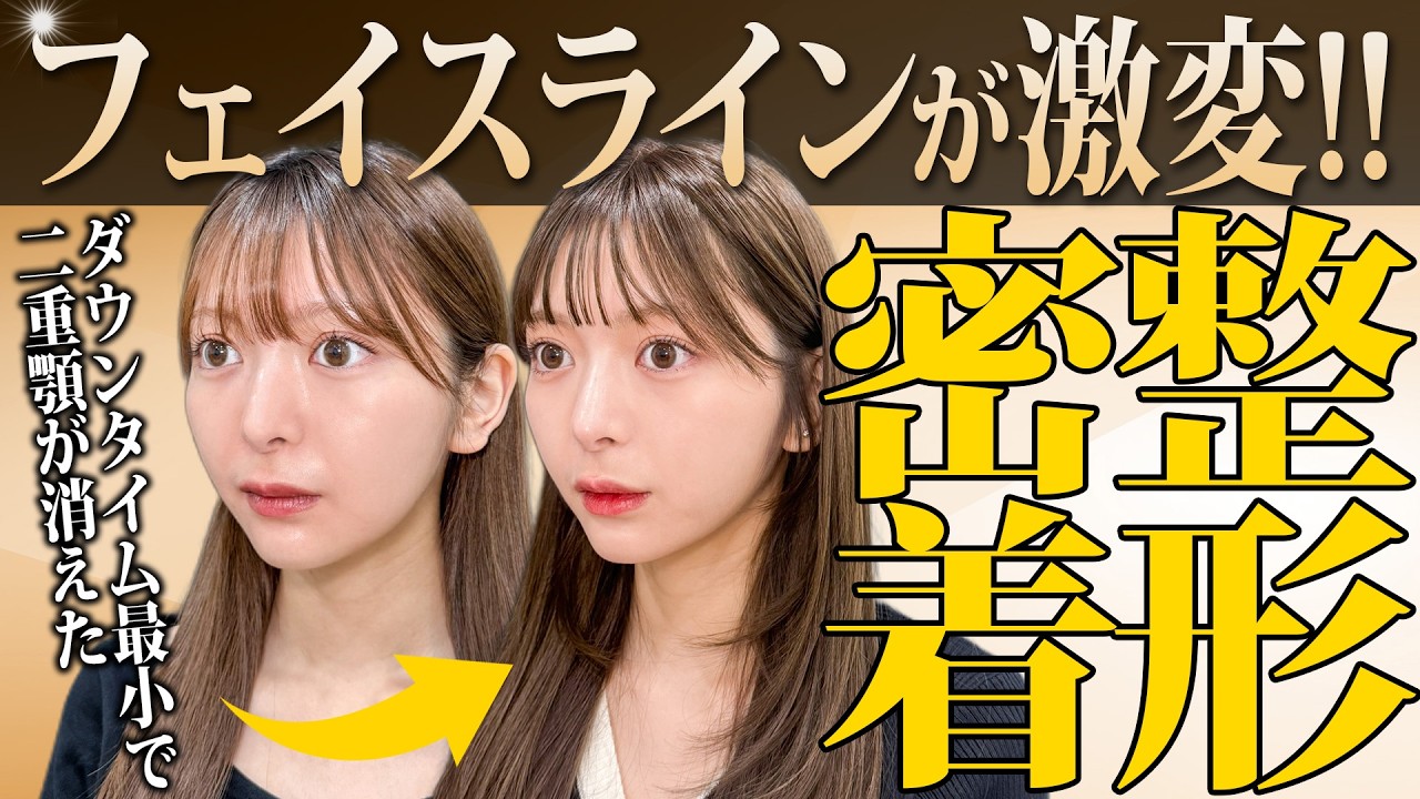 【1day小顔体験】顔下半分のもたつきは変わる？脂肪吸引＆糸リフトのリアル経過