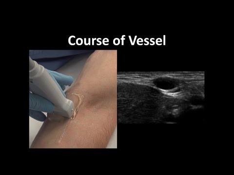 Ultrasound-Guided Peripheral Vascular Access -- BAVLS