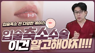 [입술 성형] 입술 축소 무작정 줄이고 제거하는 것이 아니다! 가지고 있는 입술 고민 여기 있네❤