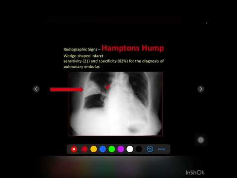 Pulmonary embolism radiology
