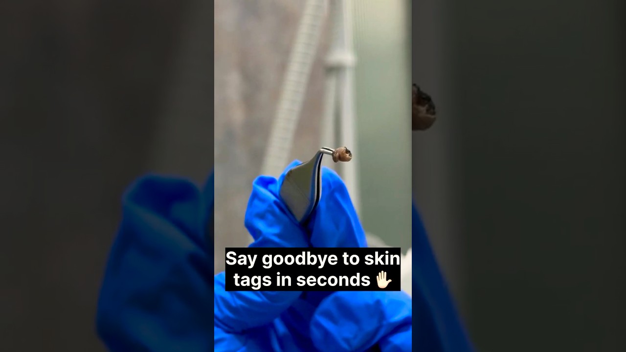 Skin Tag Removal