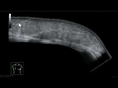 Fundamentos para a avaliação por imagem do TRAM (retalho transverso do músculo reto abdominal)