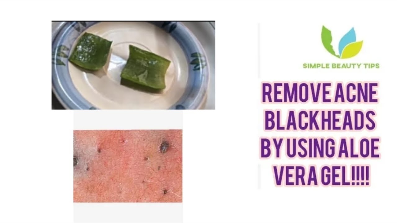 How to use Aloe Vera to Get Rid of Acne and Blackheads | Thank you youtube!