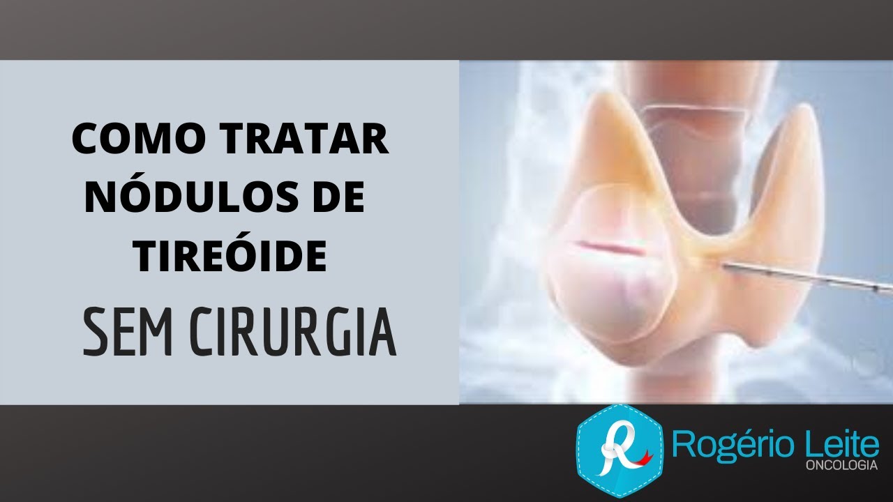 Como Tratar Nódulo De Tireoide Sem Cirurgia [Dr. Rogério Leite]