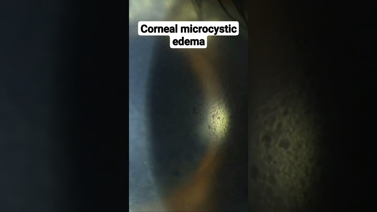 Corneal microcystic edema
