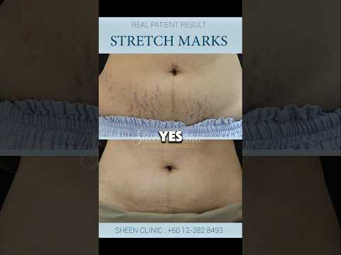 Can Stretch Marks Fade? Real Patient Before & After Result