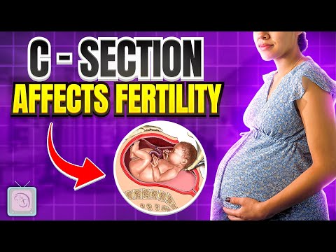 Fertility problems Miscarriages Could you have Asherman s Syndrome