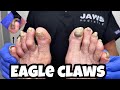 CUTTING A CROOKED LONG TOENAIL