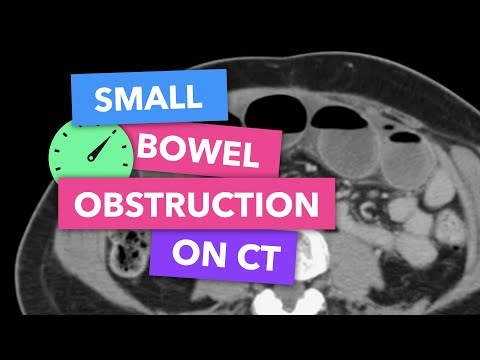 Small bowel obstruction on CT - Radiopaedia's Emergency Radiology Course