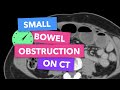 Small bowel obstruction on CT - Radiopaedia's Emergency Radiology Course
