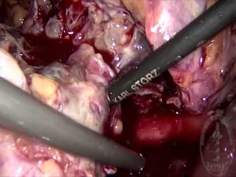 Partial Nephrectomy - Tumor Excision