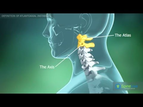 tratament articular fonoforeză