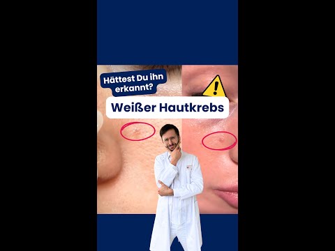 White skin cancer | DERMAFY #shorts