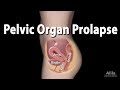 Pelvic Organ Prolapse, Animation