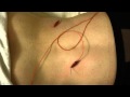 Catherine Holland Accupuncture And Electrostim Theraphy