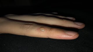 how to get rid of a burn blister on your finger