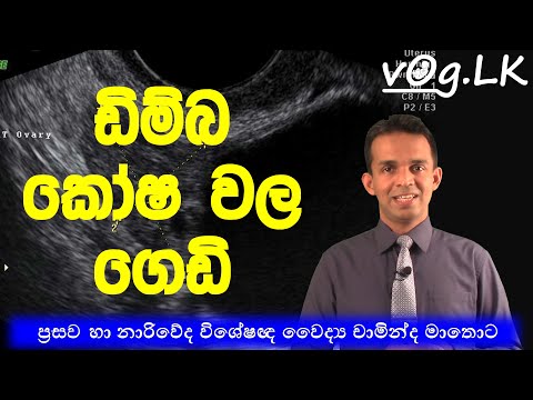 Ovarian cysts. ඩිම්බ කෝෂවල ගෙඩි