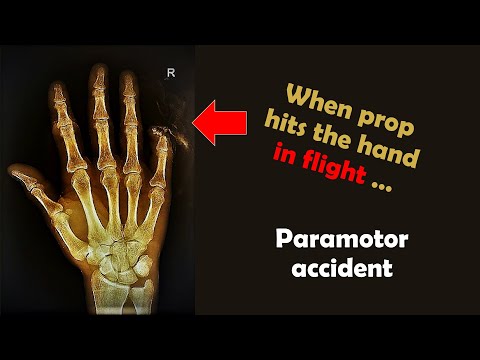 Unfallbericht: Hand im Propeller im Flug (Paramotor) (english subtitles!)