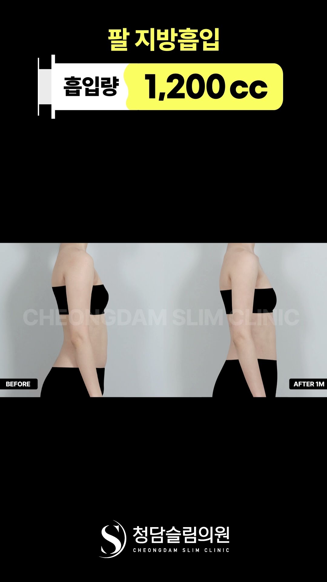 어깨 깎은 줄… 팔 지방흡입 효과 