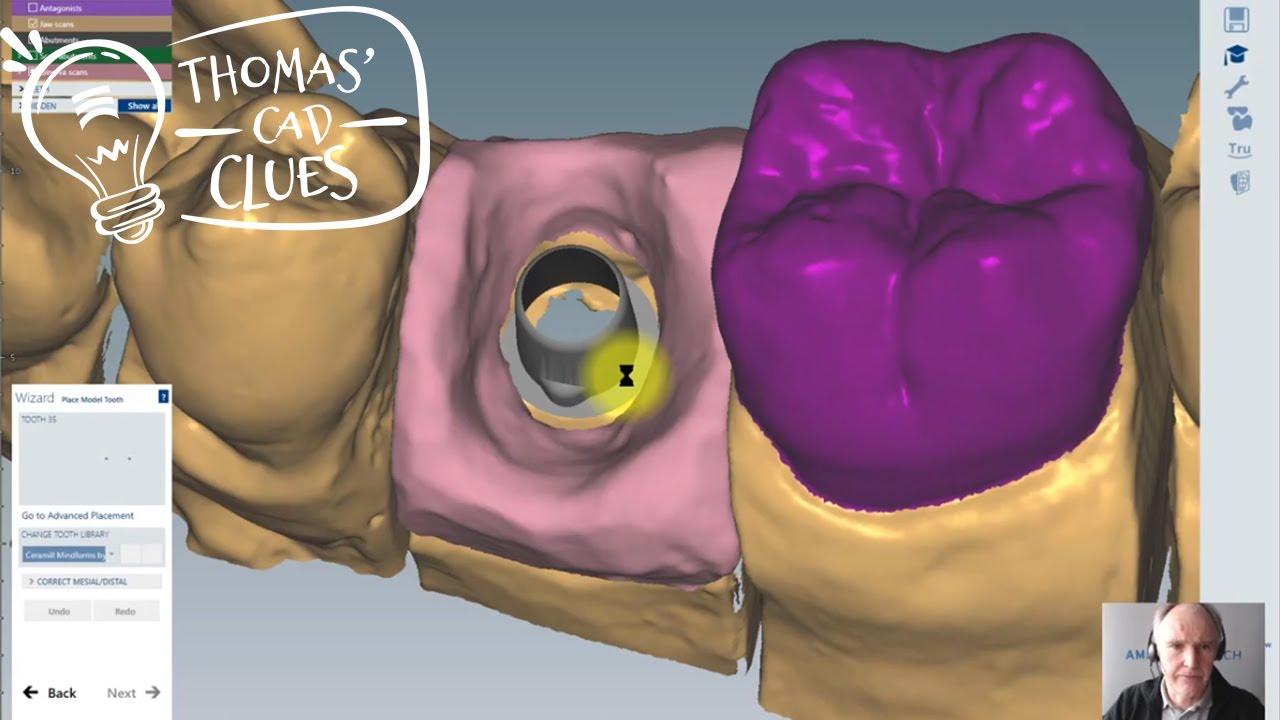 Thomas‘ CAD Clue #2 – Emergenzprofil freiformen in der Ceramill Mind CAD software