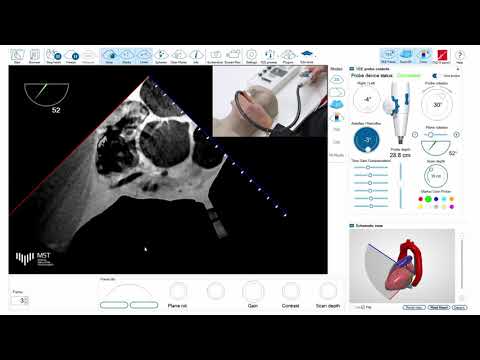 Bicuspid aortic valve BAV - check description for BlackWeek promotion