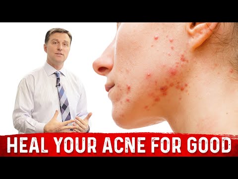 Heal Your Acne For GOOD!