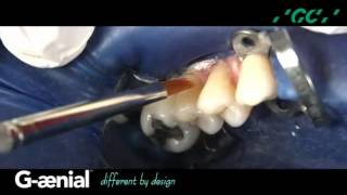G-ænial: Class V Restoration - Restoring the Maxillary Right Premolars (Video)