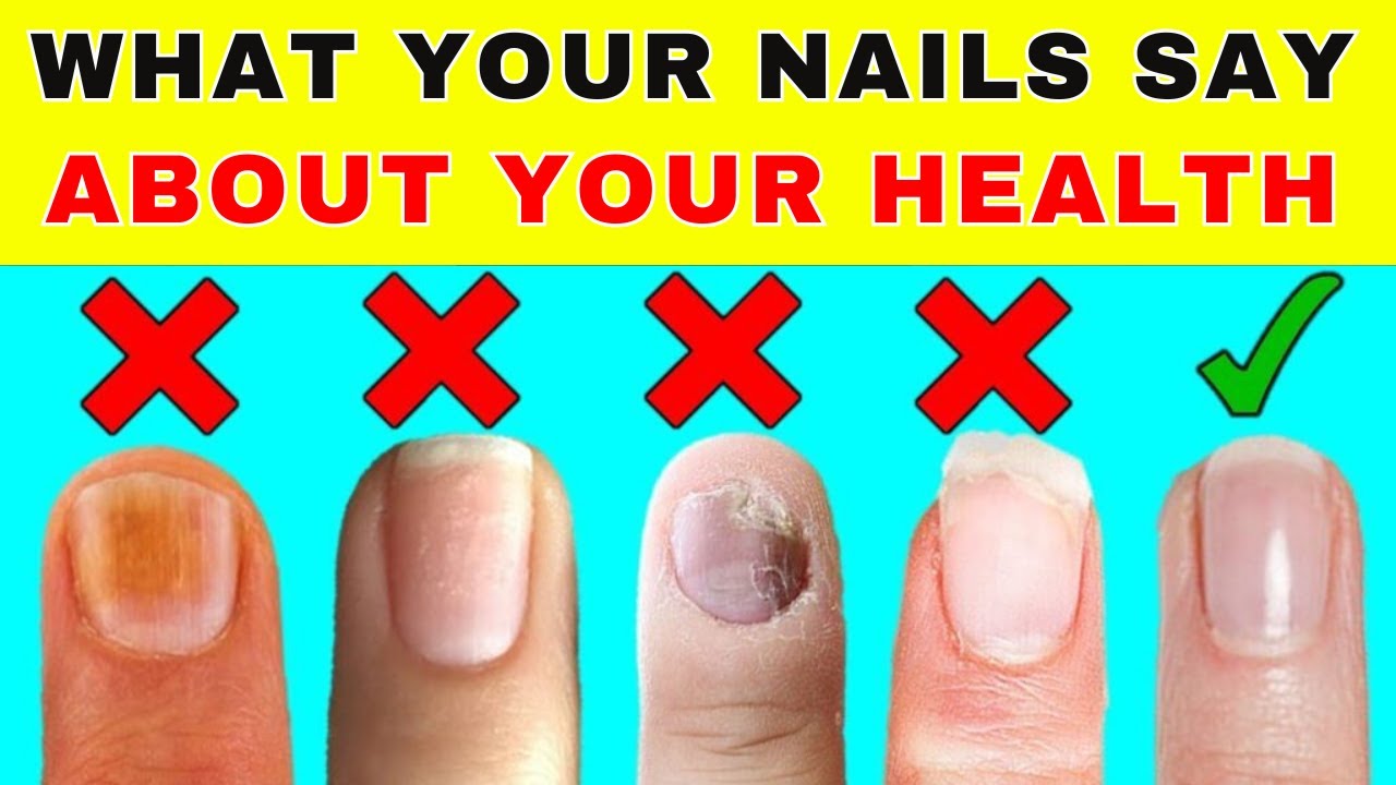 If Your Nails Look Like This, You Might Have a Health Issue!