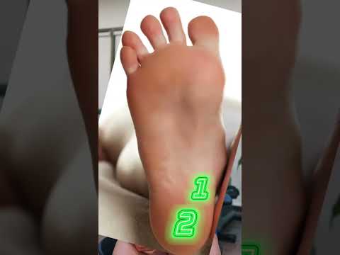 Not ALL heel pain is Plantar Fasciitis! #heelpain