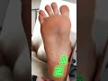 Not ALL Heel Pain Is Plantar Fasciitis Heelpain