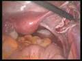 Mature TERATOMA excision - YouTube