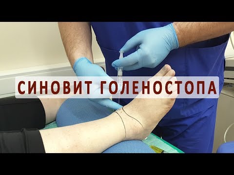 Артроз коленного сустава видео операция Боль в животе и пояснице горечь в рту
