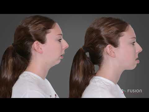 Lecture on Orthognathic Surgery (2019) - YouTube