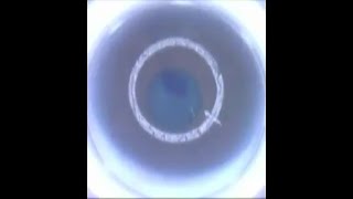 Intracorneal ring implantation by femtolaser