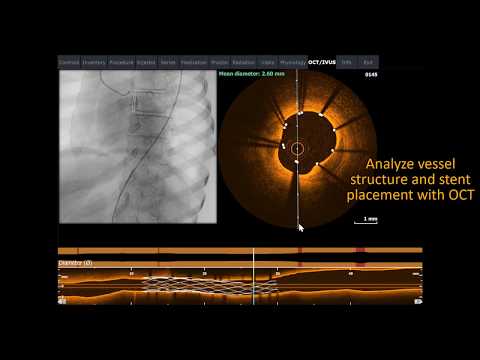 Mentice - Coronary Intermediate