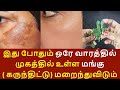 மங்கு மறைய முகத்தில் உள்ள மங்கு விரட�