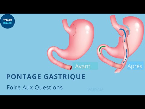 PONTAGE GASTRIQUE