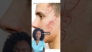 Download lagu Red Spots on Your Face | Acne Papules   Products #acne mp3