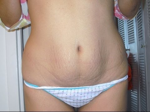 Kahit treadmill mabuti para sa pagkawala timbang Karayom upang mawala ang timbang sa Tver