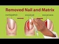 Nail Removal, Treatment for Onychogryphosis 