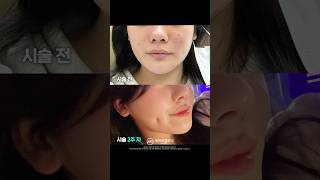 피부 좋은 사람은 다 하는 리쥬란 후기