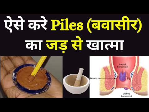 Bawaseer ka ayurvedic ilaj | Piles Treatment at Home in Hindi |पाइल्स का जड़ से खात्मा | #pilesclinic